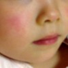 りんご病、子供の顔の様子