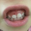 子供が歯と歯茎を強打し内出血