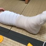 子供が足首を剥離骨折。ギプスをしている様子