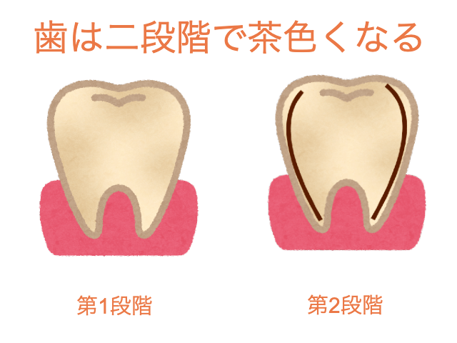 40代になり二段階で歯が変色してきた図